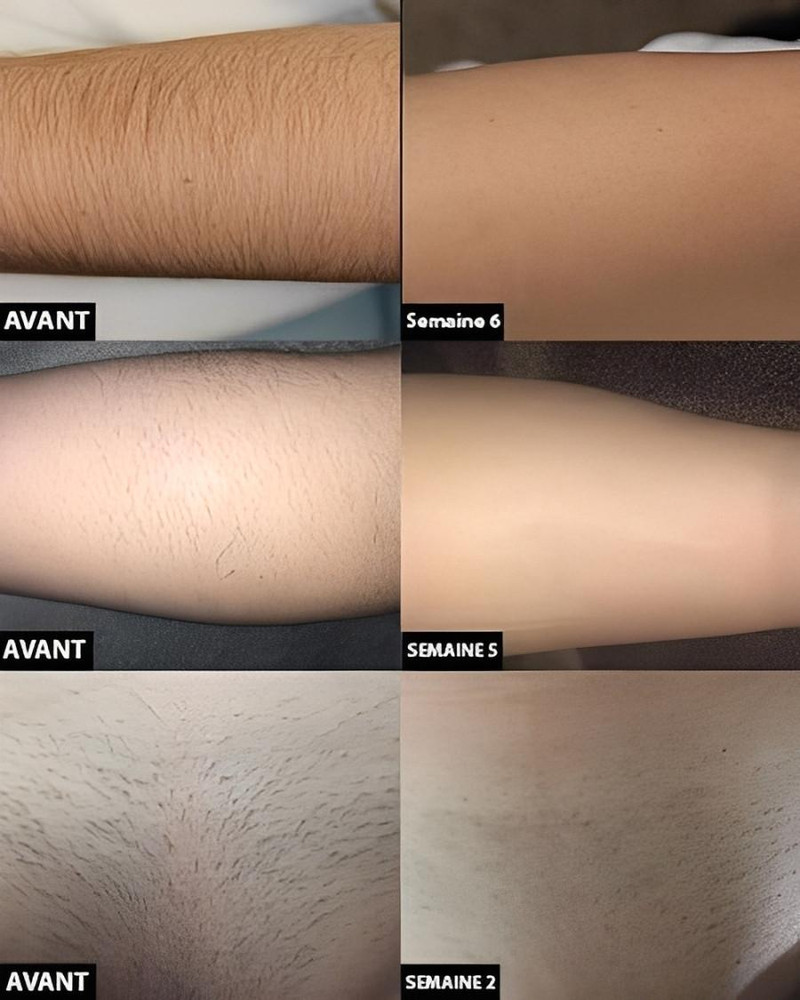 Épilateur laser permanent – Image 6