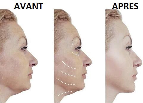 Autocollants lifting visage invisibles en gros plan