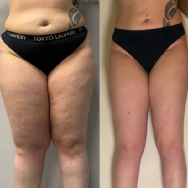 Femme confiante après utilisation du drainant lymphatique