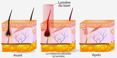 Résultats visibles après utilisation de l'épilateur laser