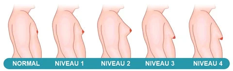 Illustration classification gynécomastie masculine