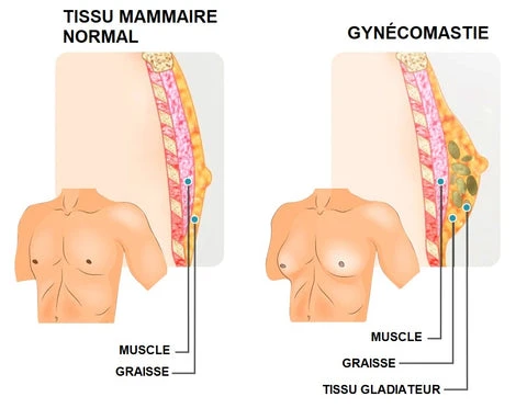 Schéma causes hormonales de la gynécomastie