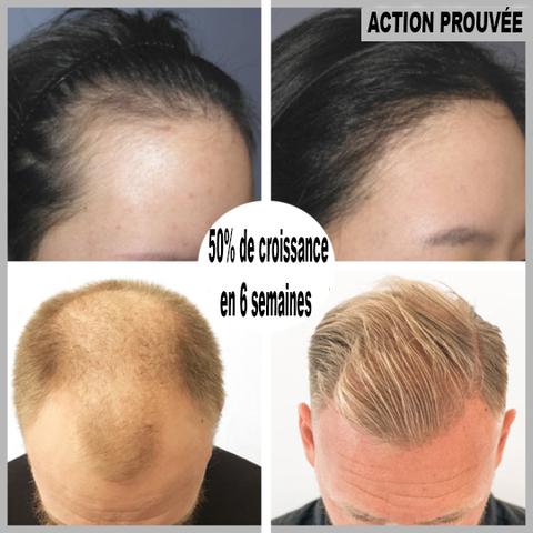 Facteurs influençant la chute des cheveux expliqués